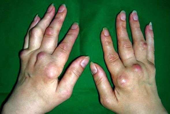 Ձեռքեր, որոնք ախտահարված են պոլիոստեոարթրիտի դեֆորմանսով